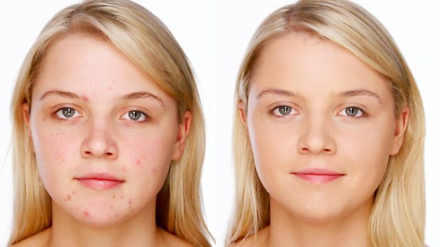 Acne/Blemish Covering Makeup – Foundation & Concealer Tutorial