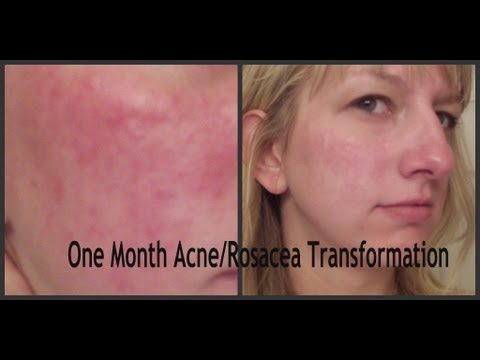 Dry Acne Prone Skin/ Rosacea Skin Care Routine! One Month Transformation!