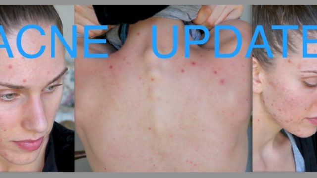 Acne Update For Acne Awareness Month! Sunscreen, Skincare Routine, Summer & Herbal Supplements!