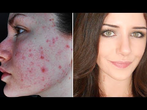 How To Cover Acne & Scars | Simple Makeup Transformation Routine