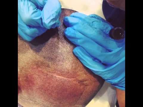 Semi Permanent Make up – Scalp camouflage video by Medicos London