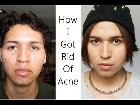 My Skincare Routine (For Acne)  * How I Got Rid Of Acne